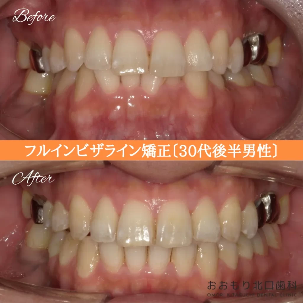 症例紹介⑩フルインビザライン(30代後半男性) img