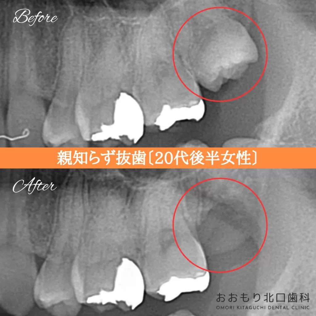症例紹介⑪親知らず抜歯(20代後半女性) img