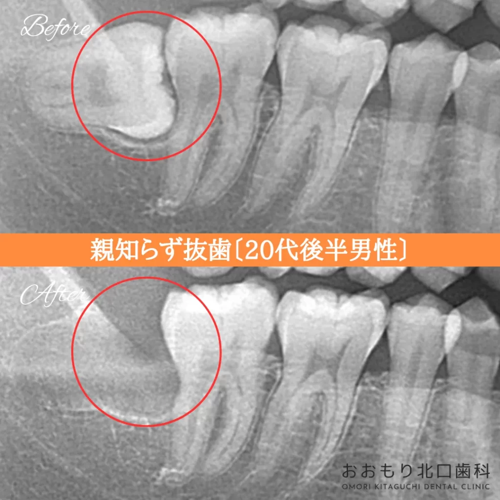 症例紹介⑫親知らず抜歯(20代後半男性) img