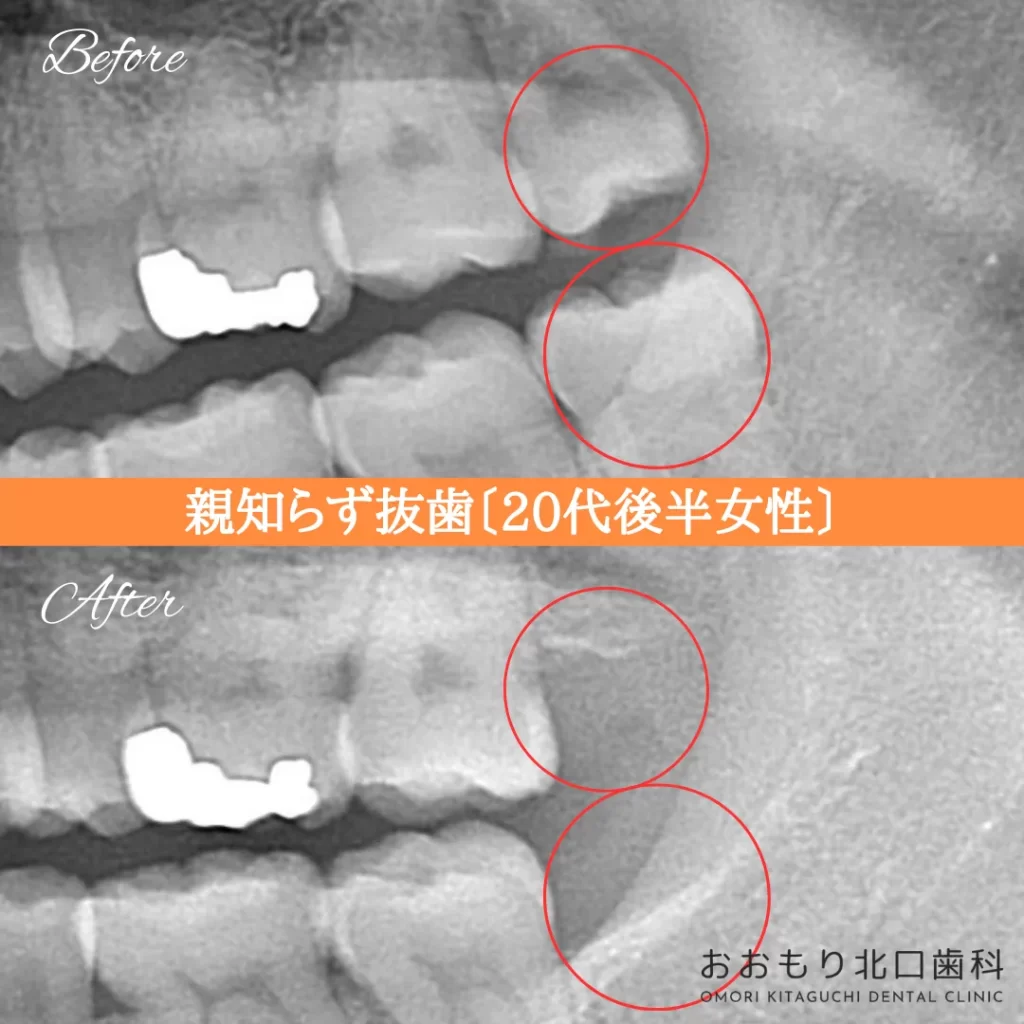 症例紹介⑬親知らず抜歯(20代後半女性) img
