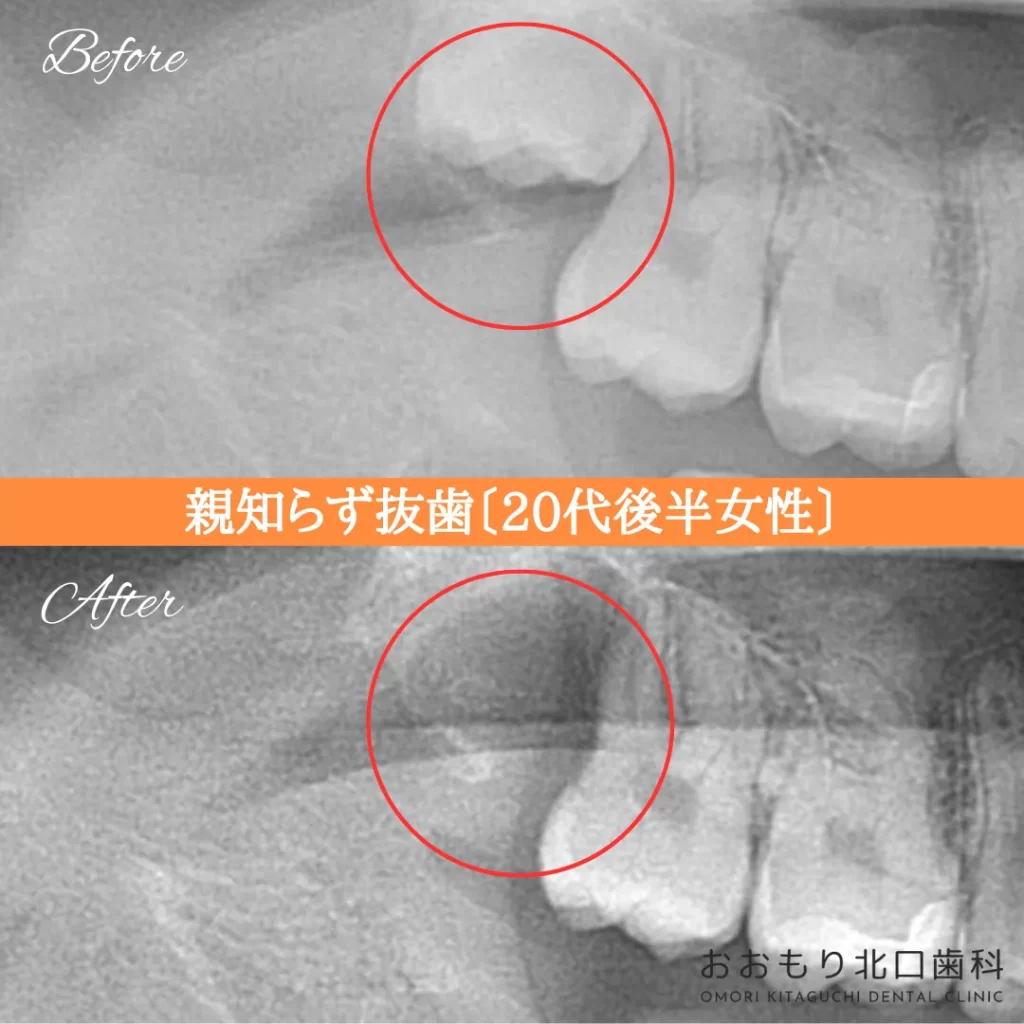 症例紹介⑭親知らず抜歯(20代後半女性) img