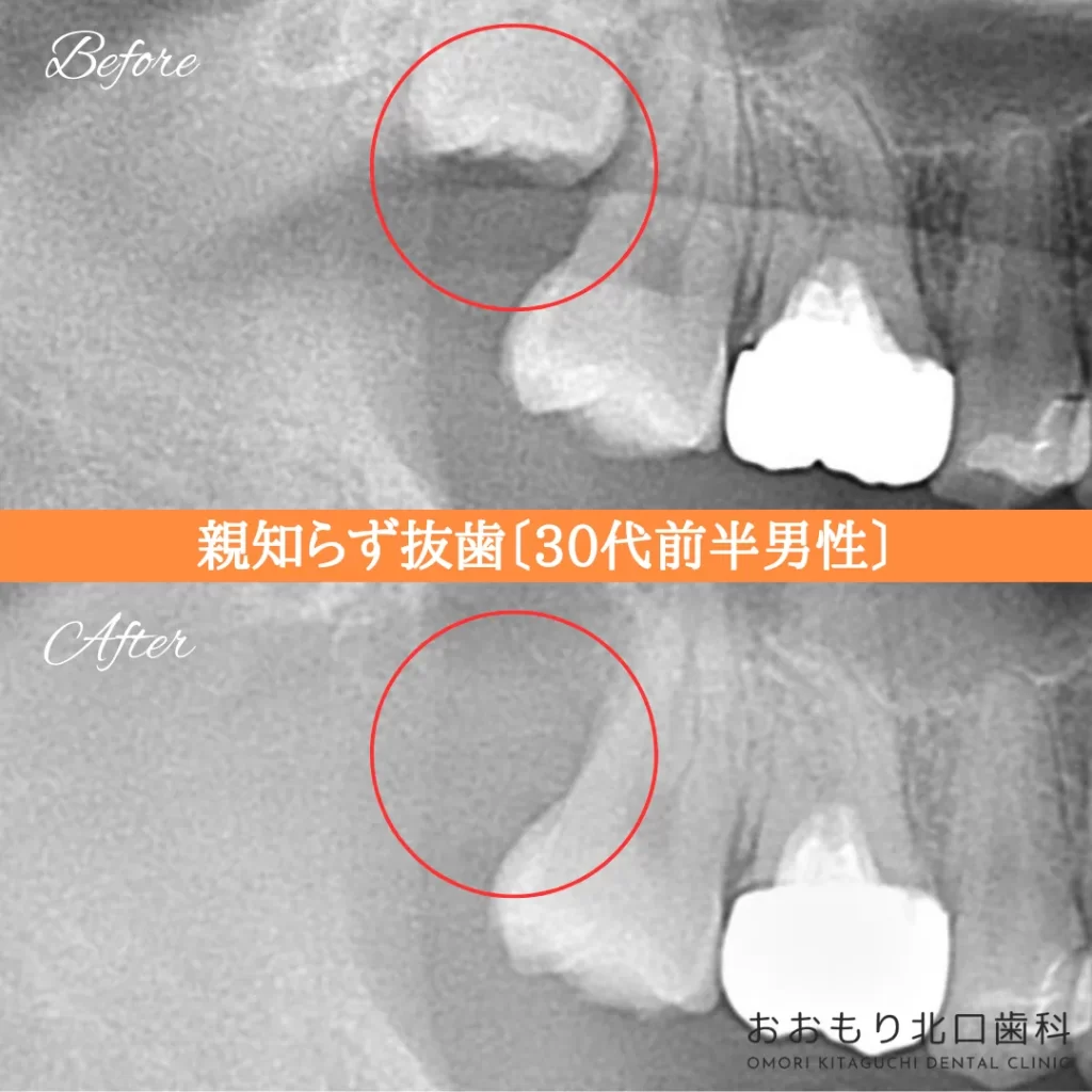 症例紹介⑮親知らず抜歯(30代前半男性) img