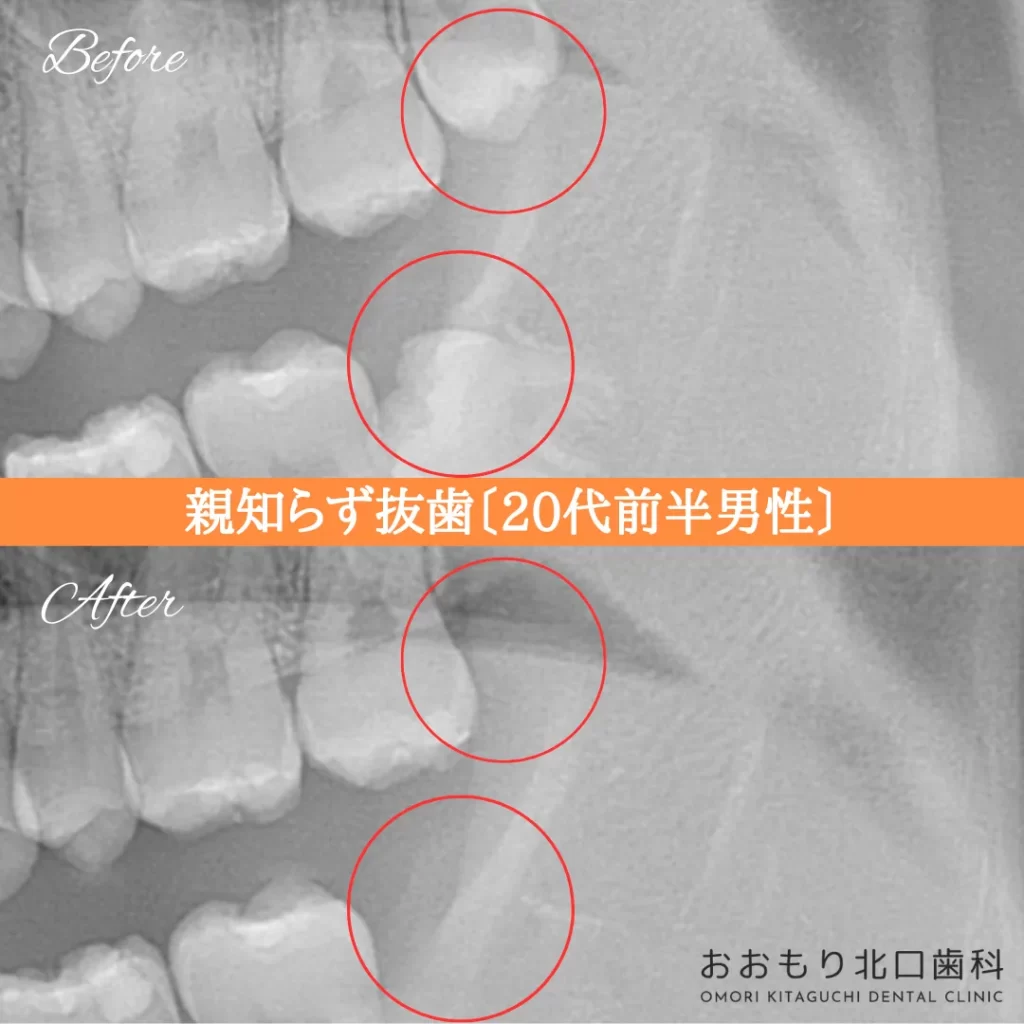 症例紹介⑰親知らず抜歯(20代前半男性) img