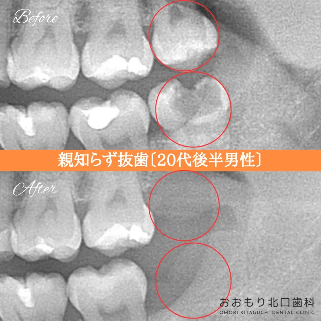 症例紹介⑱親知らず抜歯(20代後半男性) img