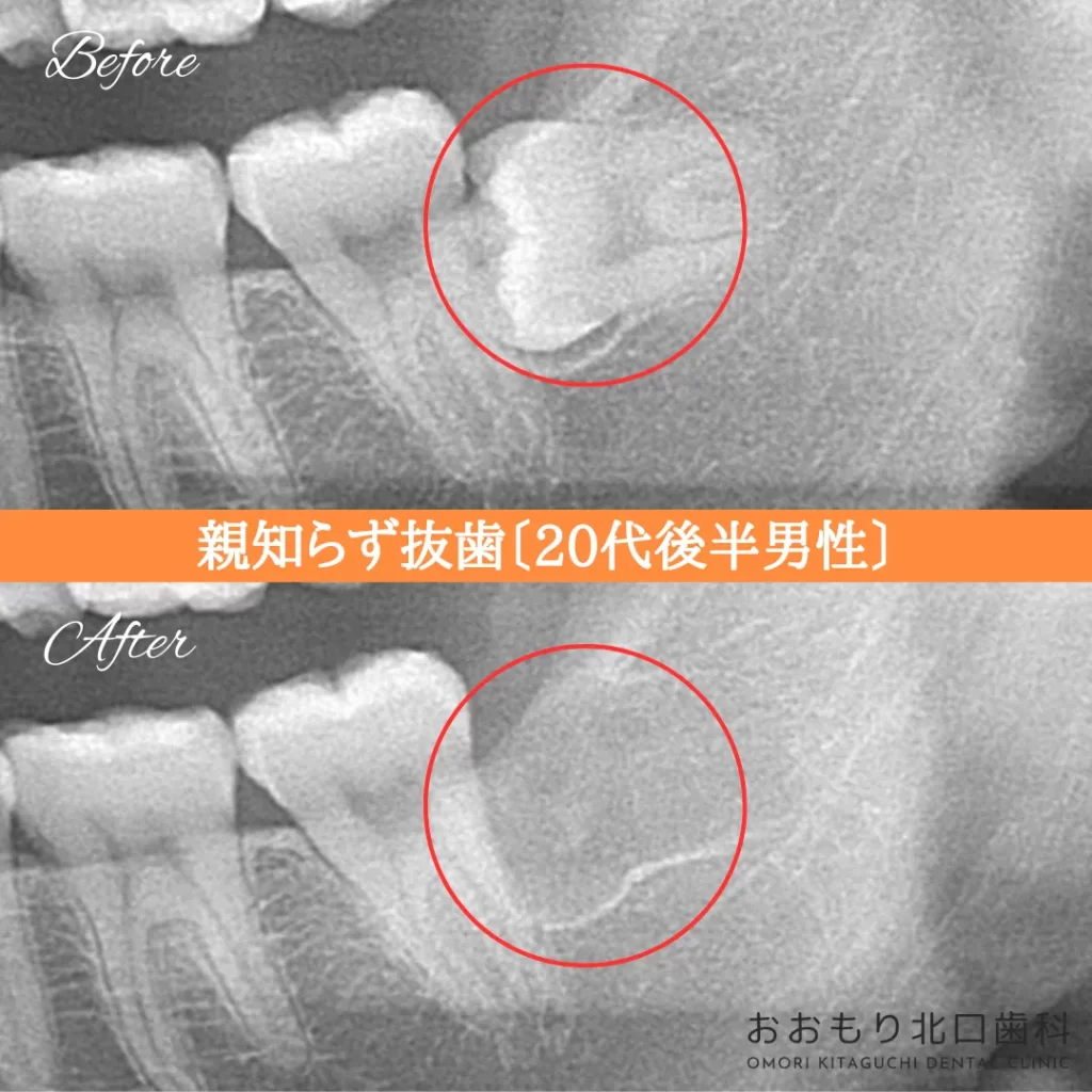 症例紹介⑲親知らず抜歯(20代後半男性) img