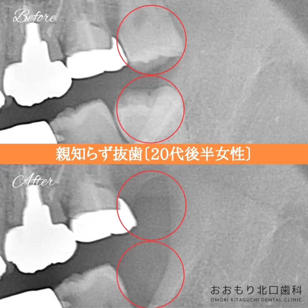症例紹介⑳親知らず抜歯(20代後半女性) img