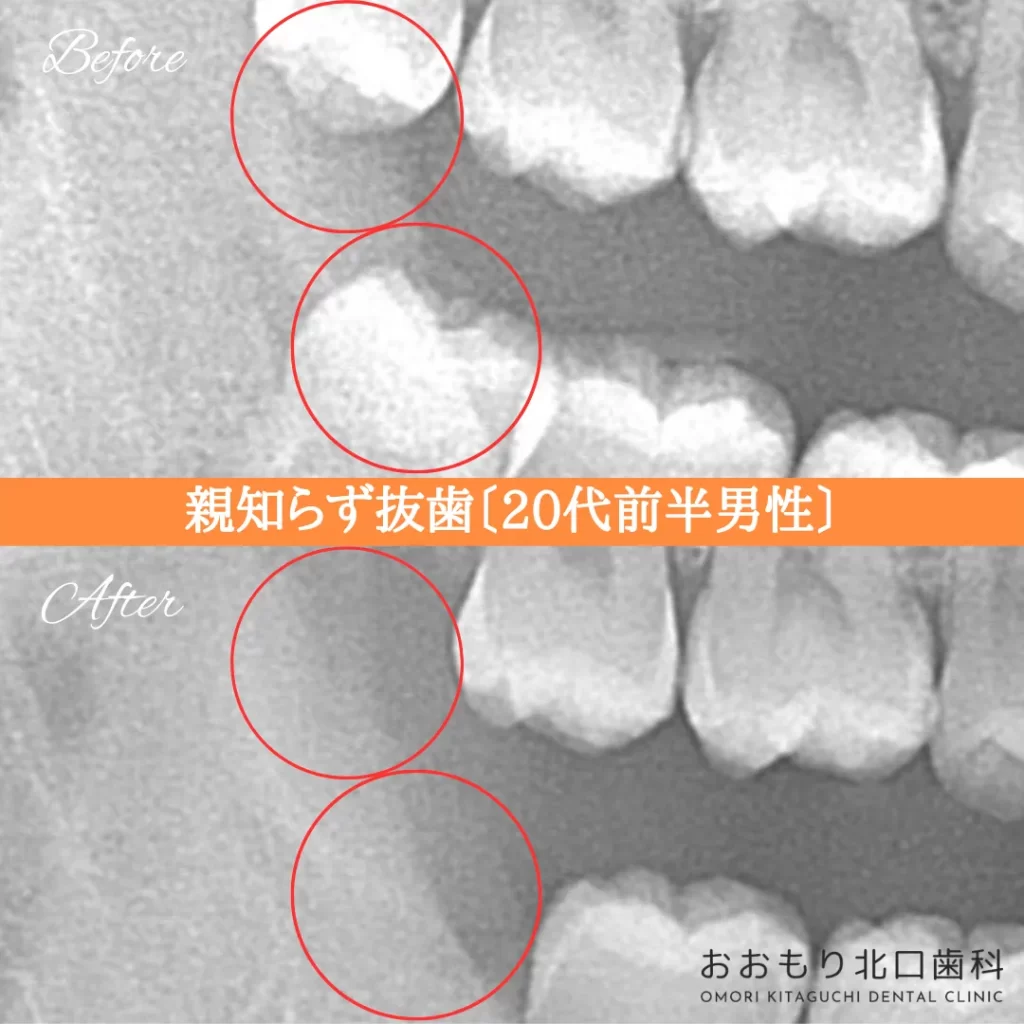 症例紹介㉑親知らず抜歯(20代前半男性) img
