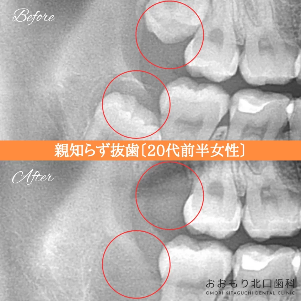 症例紹介㉒親知らず抜歯(20代前半女性) img