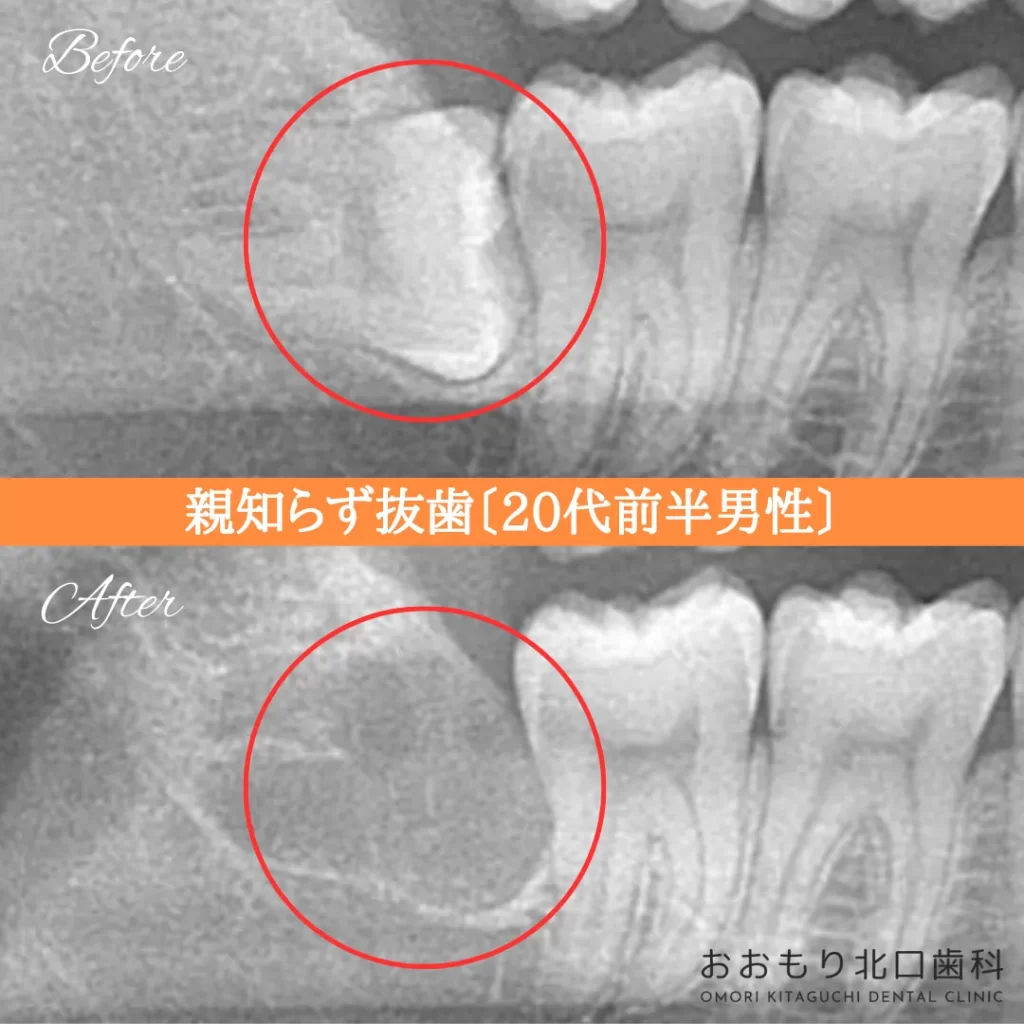症例紹介㉗親知らず抜歯(20代前半男性) img