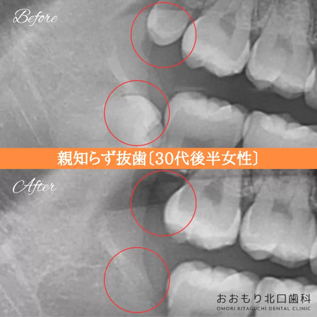 症例紹介㉘親知らず抜歯(30代後半女性) img