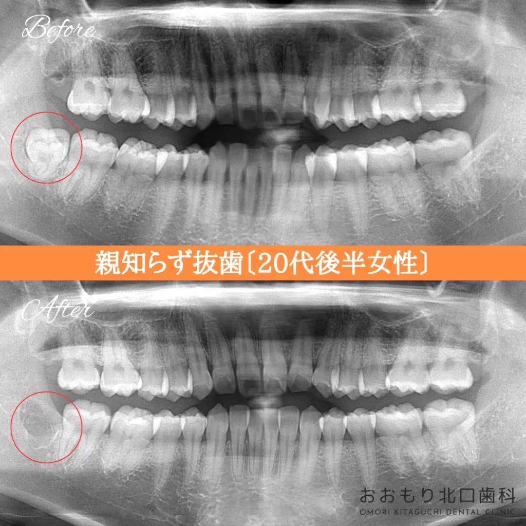 症例紹介㊱親知らず抜歯(20代後半女性) img