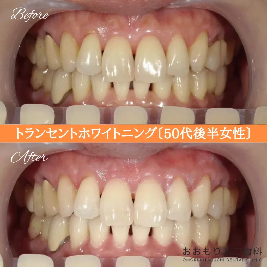症例紹介62トランセントホワイトニング(50代後半女性) img
