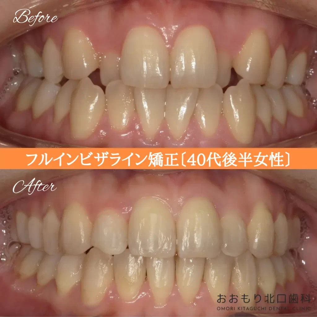 症例紹介⑧フルインビザライン(40代後半女性) img